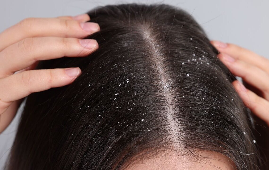 Uzmanların önerdiği ev yapımı doğal karışım saçtaki kepekleri kısa sürede yok ediyor