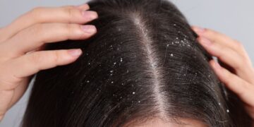 Uzmanların önerdiği ev yapımı doğal karışım saçtaki kepekleri kısa sürede yok ediyor